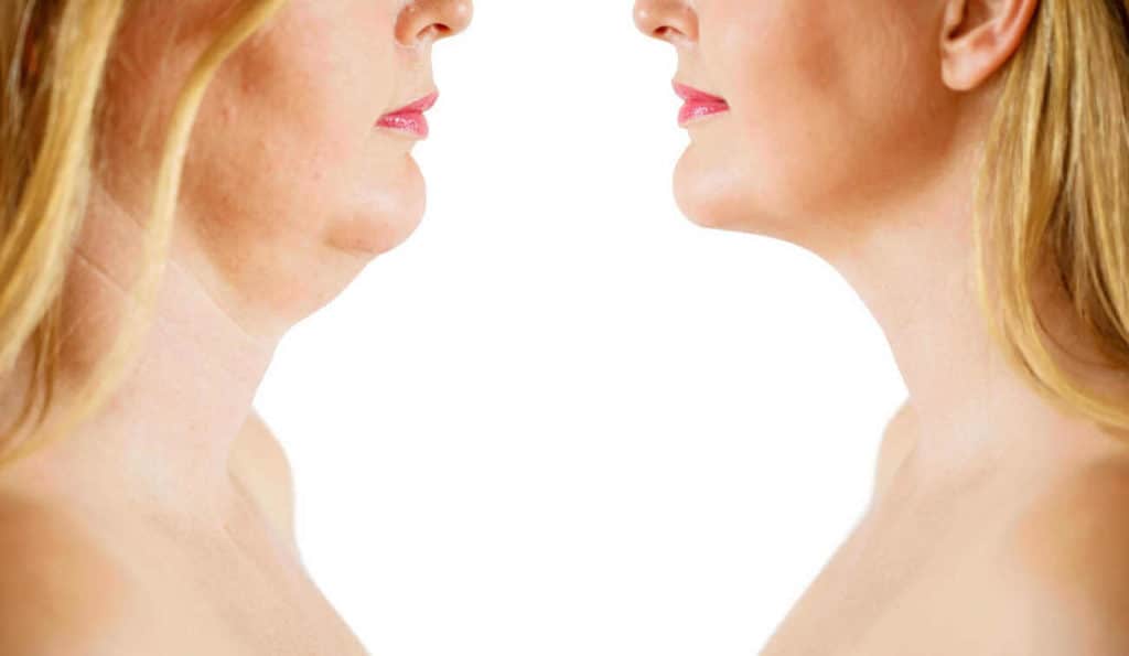 Double Chin treatment Congleton before and after results