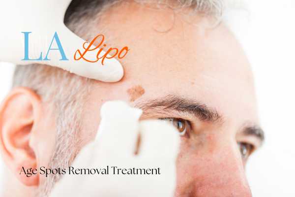 What Are the Most Effective Treatments for Age Spots Congleton?