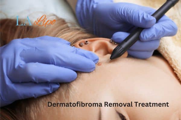 Dermatofibroma Removal Treatment Congleton