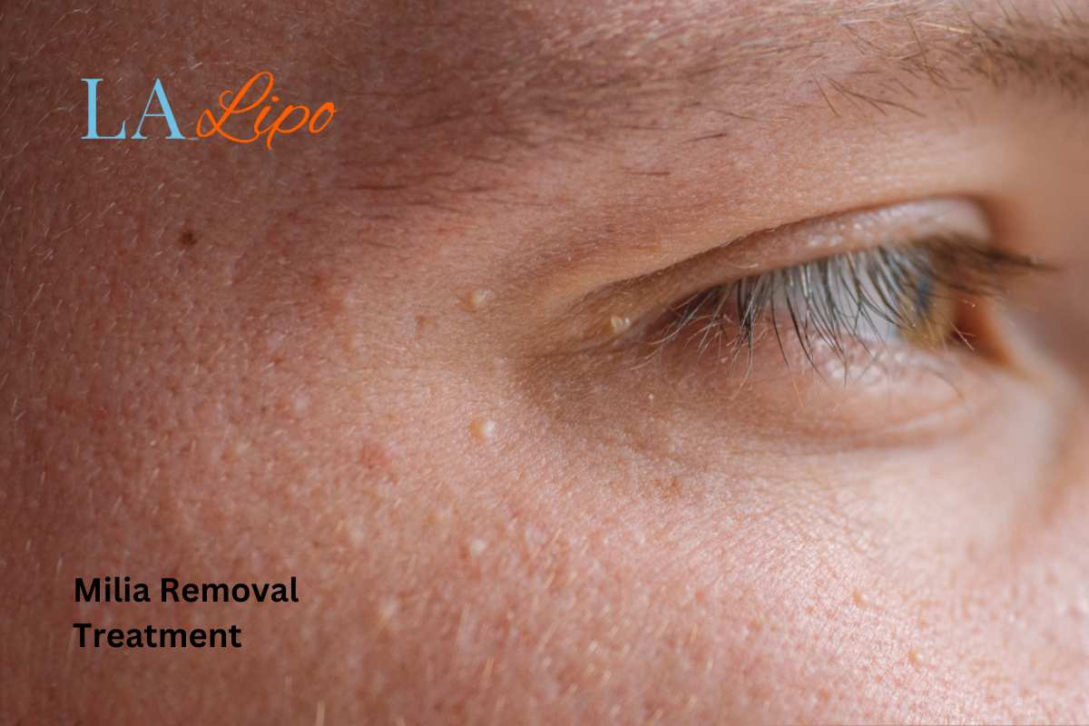 Cryopen Milia Removal: Is It the Easiest and Safest Option Congleton?