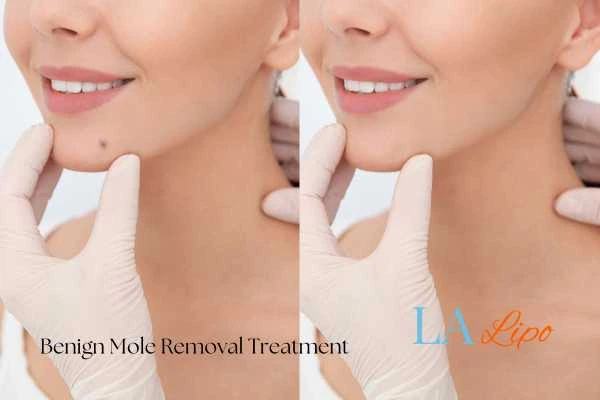 Before-and-after results following benign mole-removal treatment Congleton