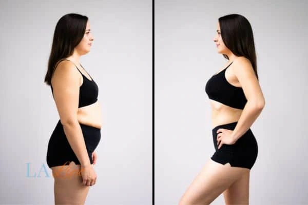 image of woman before and after results of LA-EMS Body Sculpting Congleton to help treat Diastasis recti