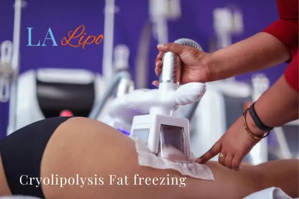 women getting fat freezing Congleton