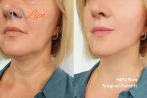 hi-fu for wrinkles Congleton before and after results