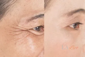 Before and after results of woman - HI-fu wrinkles reduction treatment Congleton