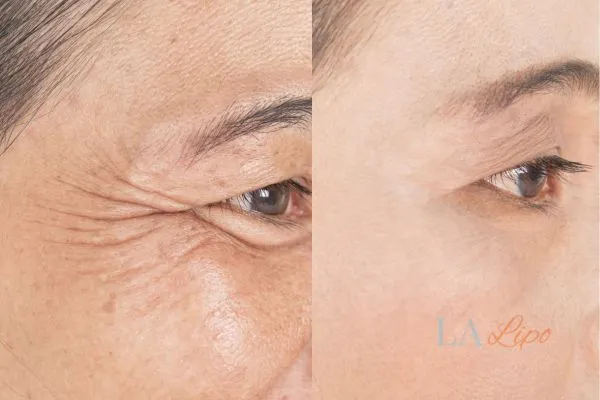 Before and after results of woman - HI-fu wrinkles reduction treatment Congleton