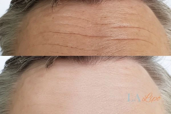 results of HIFU Congleton on mans forehead to help reduce lines and wrinkles