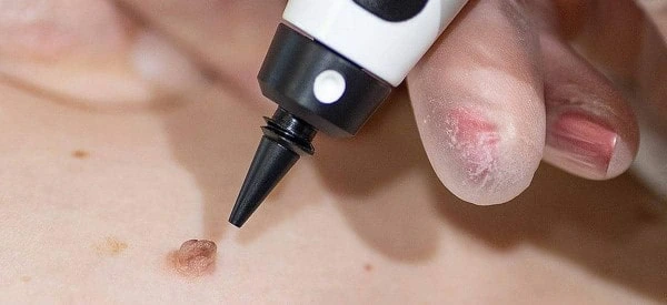 skin tag removal using cryopen Congleton