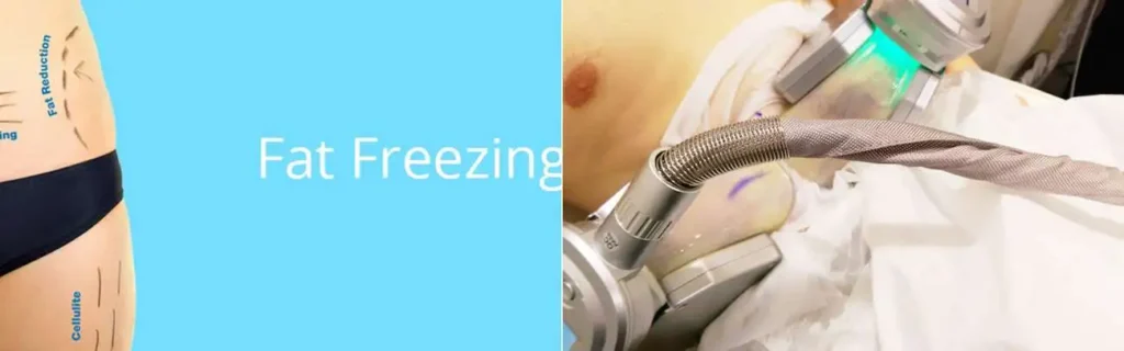 Fat freezing Congleton on multiple areas of the body