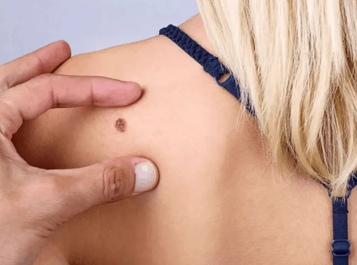 woman having mole removal Congleton consultation before treatment.