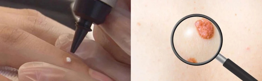CryoPen practitioner Congleton assessing a benign mole before treatment