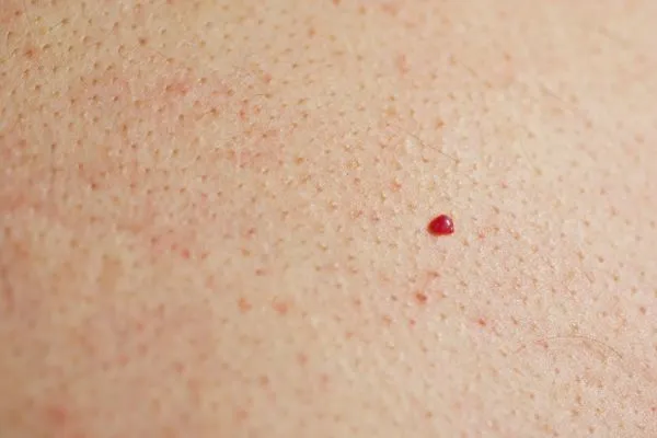 close up of a cherry angioma Congleton