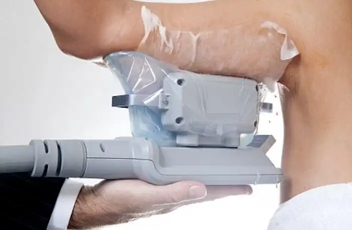 Picture of fat freezing Congleton on the upper arms.