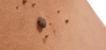 image of a skin tag Congleton