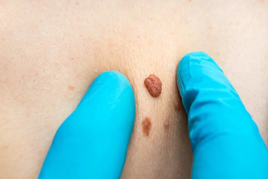 Consultant examining a skin tag Congleton