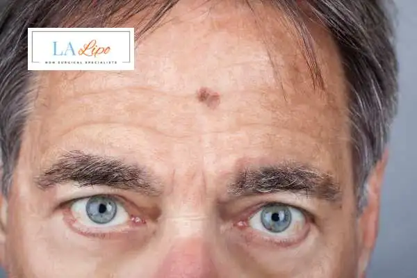 Solar Lentigo Removal Congleton image of man with mark on his forehead