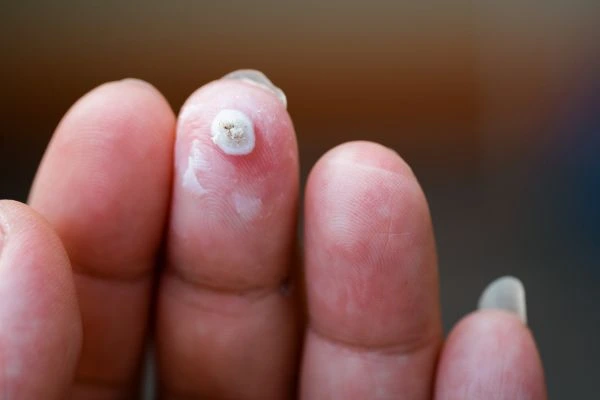 wart on person finger - cryotherapy to treat from LA LIPO Congleton
