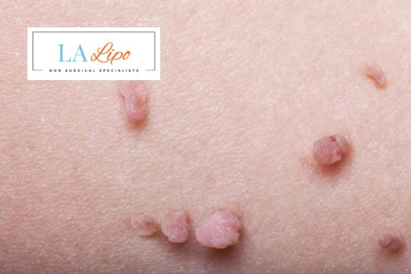 Does cryopen skin tag removal Congleton hurt? Find out now call our team today!
