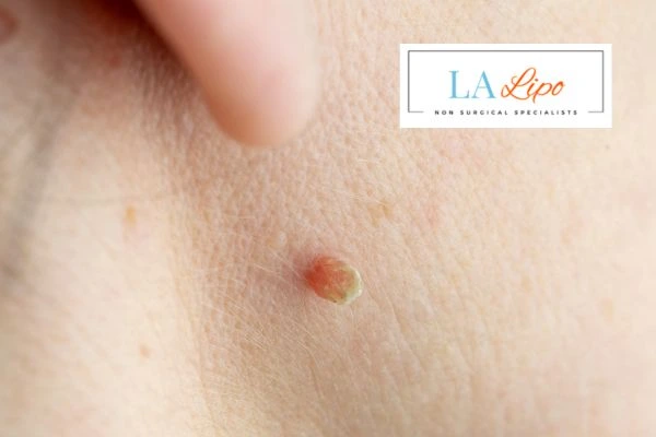 Book skin tag removal Congleton today speak to our team now!