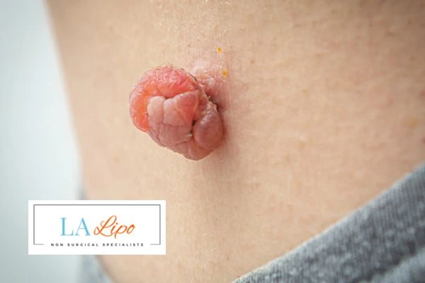 Interested in skin tag removal Congleton? Concerned about the pain? Find out more today!