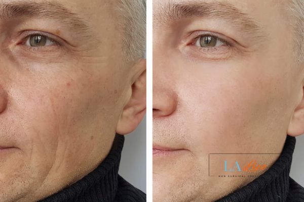 See the amazing results of Morpheus8 Treatment Congleton!