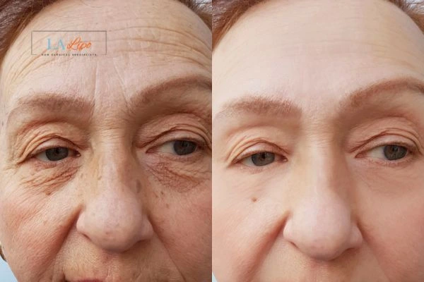 The powerful benefits of Morpheus8 Treatment Congleton - Call Our team today!