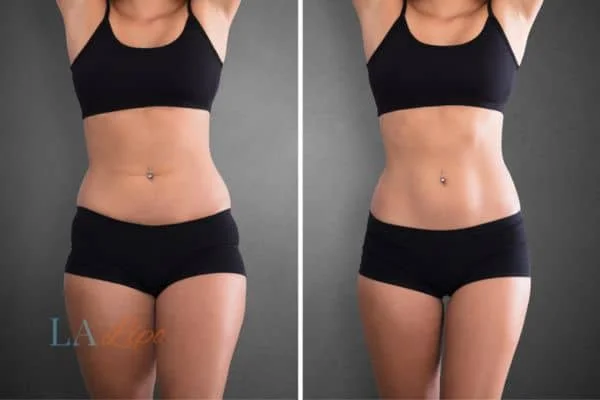 before and after results of non-surgical treatment to help a woman's body image and mental health Congleton