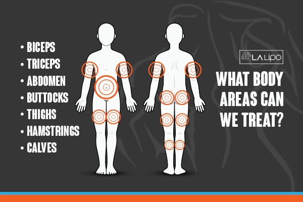 Diagram to show areas you can have LA-EMS Body Sculpting Treatment Congleton
