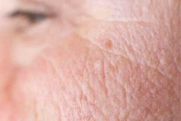 close up picture of a woman's face showing an age spot Congleton