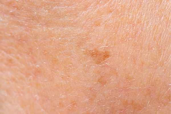 close up picture of age spots Congleton