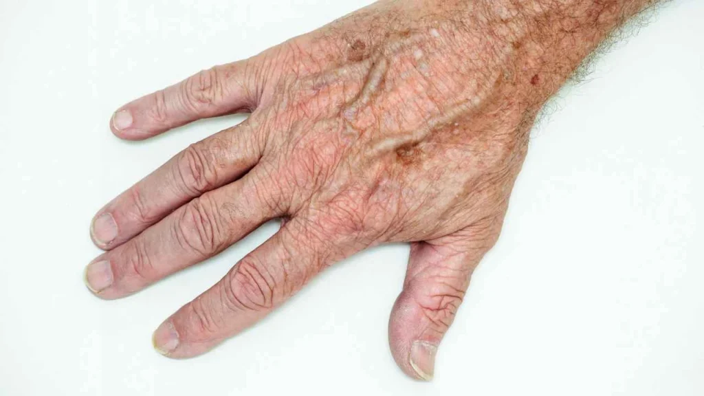 Male hand showing age spot Congleton