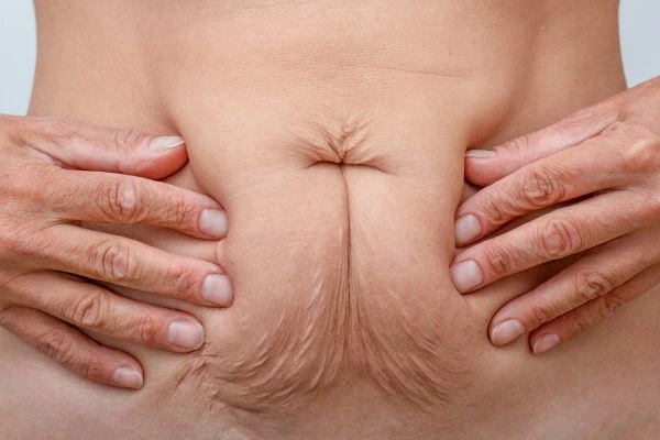 Should I Combine Diastasis Recti Treatment with Body Contouring for Better Results Congleton?