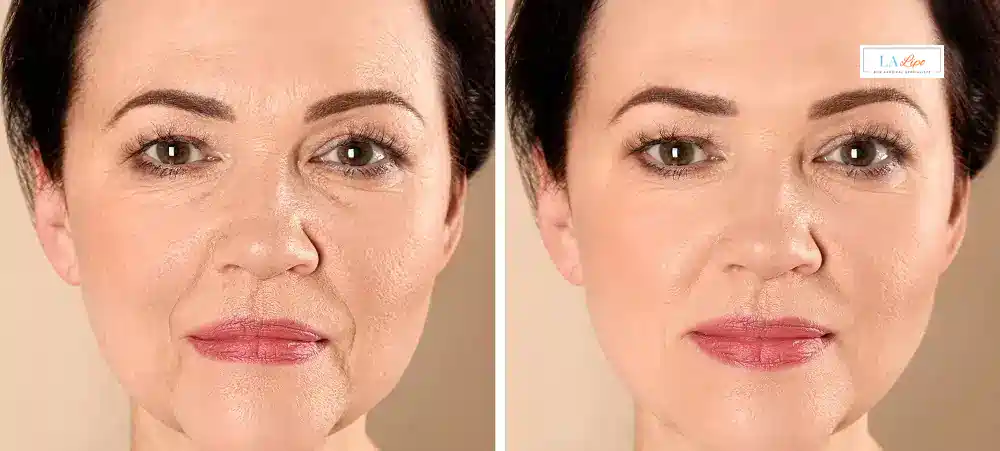 How Long Does It Take to See Results and How Long Do They Last Congleton?
