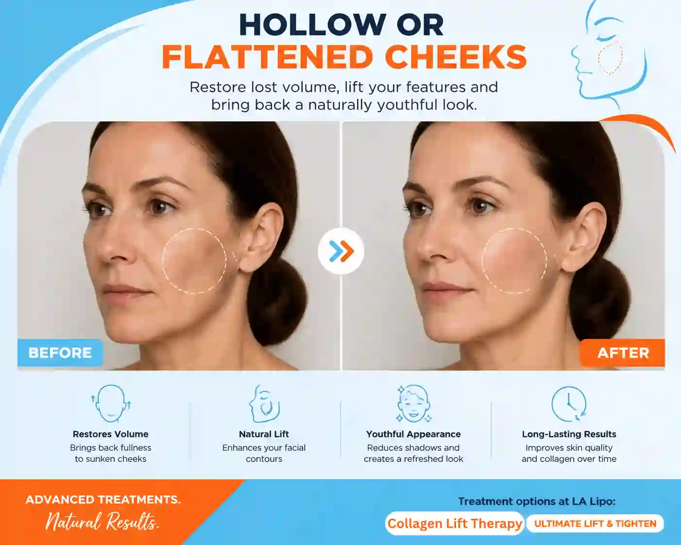 Sign #4: Hollow or Flattened Cheeks Congleton